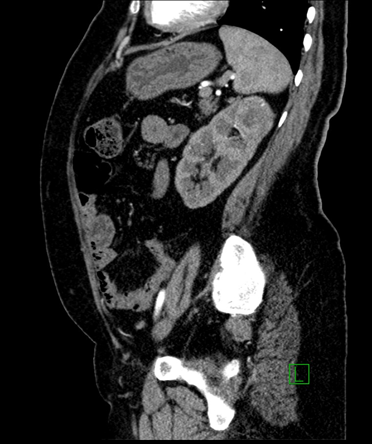 Bilateral sporadic synchronous clear cell renal cell carcinoma (Radiopaedia 85035-100575 E 42).jpg