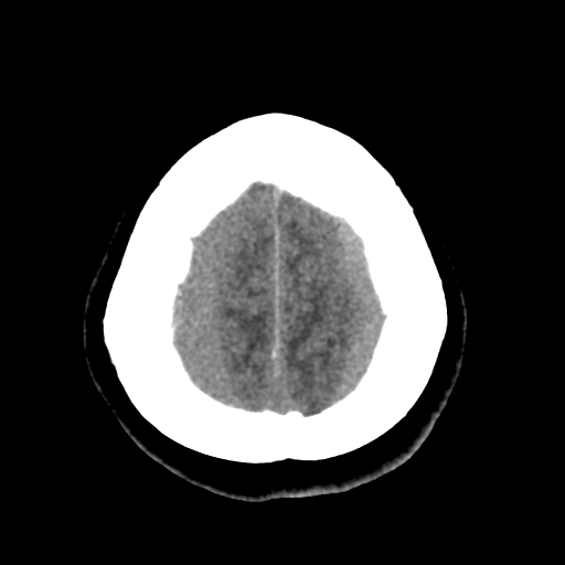 Bilateral subacute subdural hematoma (Radiopaedia 69240-79018 Axial non-contrast 45).jpg