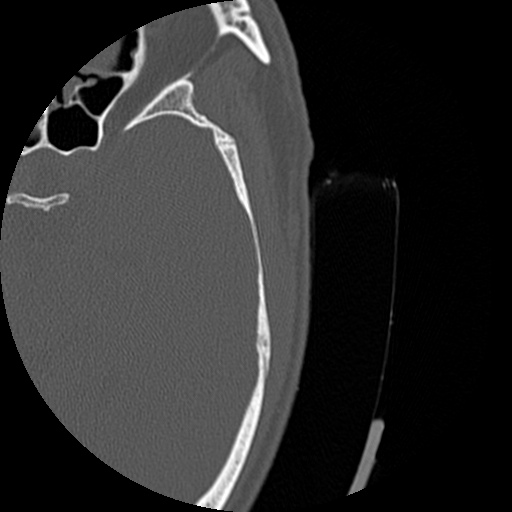 Bilateral temporal bone fractures (Radiopaedia 29482-29970 D 160).jpg