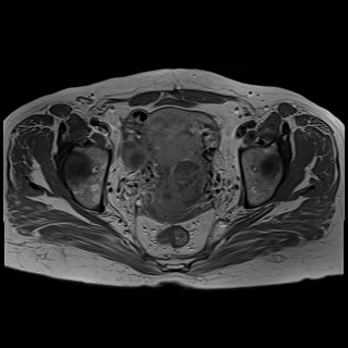 Bilateral tubo-ovarian abscesses (Radiopaedia 58635-65829 Axial T1 C+ 31).jpg