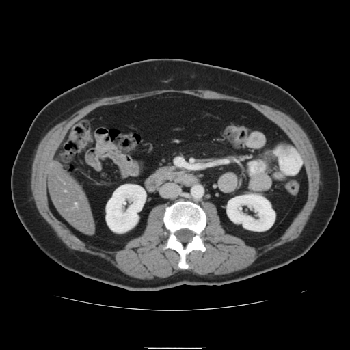 File:Billroth I gastric resection (Radiopaedia 17685-17425 None 24).jpg