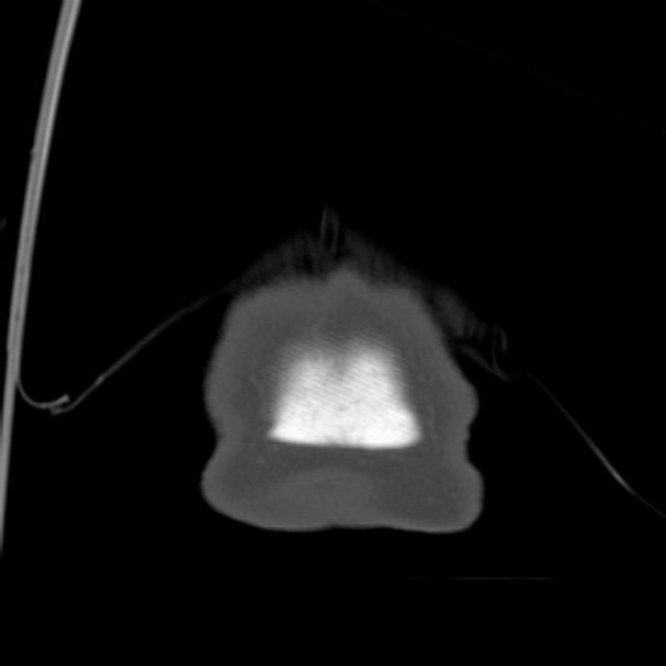 Biparietal osteodystrophy (Radiopaedia 46109-50463 Coronal bone window 107).jpg