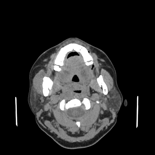 Bisphosphonate-related osteonecrosis of the jaw (Radiopaedia 71324-81642 non-contrast 96).jpg