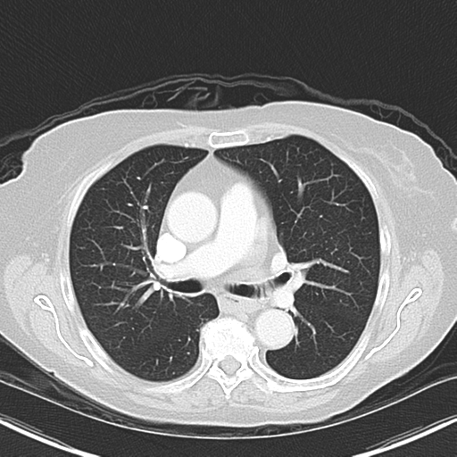 File:Bladder and bowel cancers (Radiopaedia 37688-39592 Axial lung window 24).png