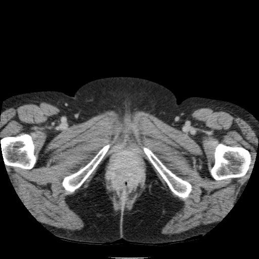 Bladder tumor detected on trauma CT (Radiopaedia 51809-57609 C 149).jpg