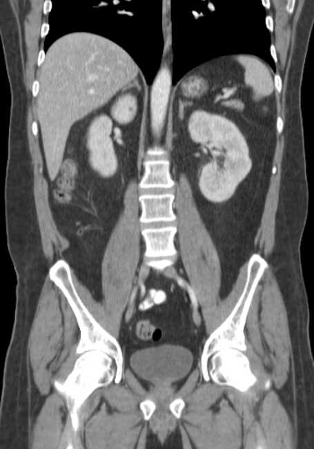 Bleeding duodenal ulcer and adenomyomatosis of gallbladder (Radiopaedia 61834-69861 B 36).jpg