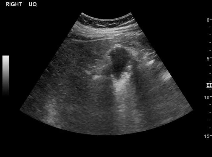 File:Bleeding duodenal ulcer and adenomyomatosis of gallbladder (Radiopaedia 61834-69873 A 5).jpg