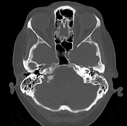File:Blood on the tentorium simulating hyperdense transverse sinus (Radiopaedia 55521-61991 Axial bone window 9).jpg