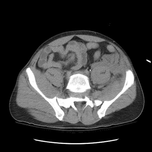 Blunt abdominal trauma with solid organ and musculoskelatal injury with active extravasation (Radiopaedia 68364-77895 Axial C+ delayed 101).jpg