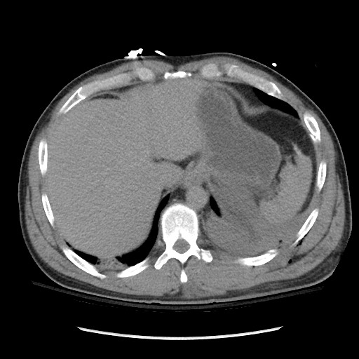 Blunt abdominal trauma with solid organ and musculoskelatal injury with active extravasation (Radiopaedia 68364-77895 Axial C+ delayed 25).jpg