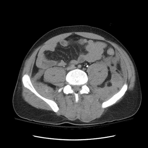 Blunt abdominal trauma with solid organ and musculoskelatal injury with active extravasation (Radiopaedia 68364-77895 Axial C+ delayed 93).jpg
