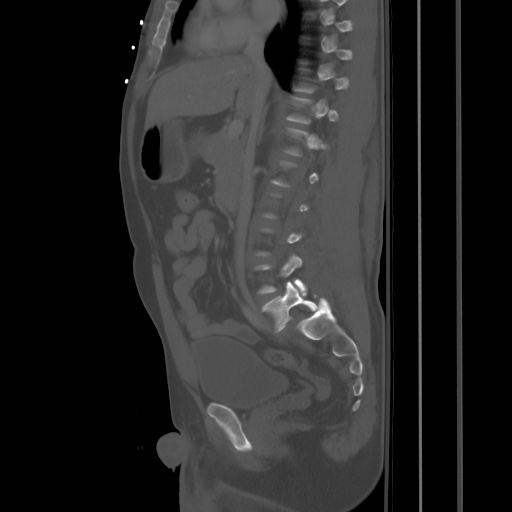 Blunt abdominal trauma with solid organ and musculoskelatal injury with active extravasation (Radiopaedia 68364-77895 Sagittal bone window 43).jpg