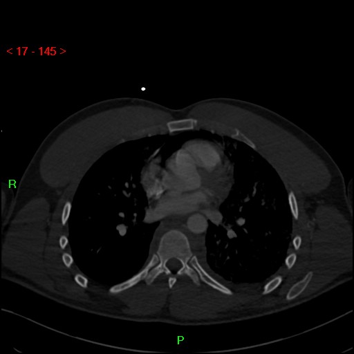 Blunt thoracic trauma (Radiopaedia 73454-84221 Axial bone window 55).jpg