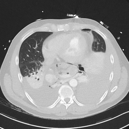 Boerhaave syndrome (Radiopaedia 39382-41661 Axial lung window 38).png