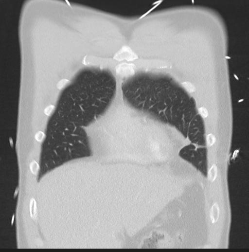 Boerhaave syndrome (Radiopaedia 39382-41661 Coronal lung window 10).png