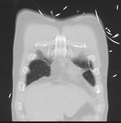 Boerhaave syndrome (Radiopaedia 39382-41661 Coronal lung window 7).png