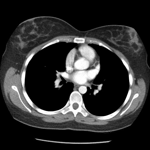 File:Borderline mucinous tumor (ovary) (Radiopaedia 78228-90808 A 24).jpg