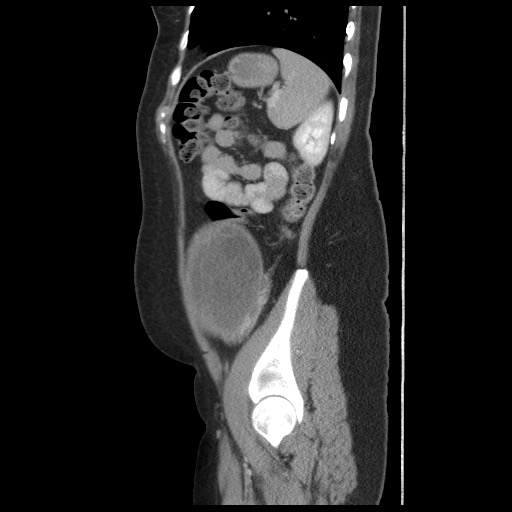 File:Borderline mucinous tumor (ovary) (Radiopaedia 78228-90808 B 51).jpg