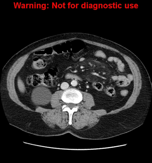File:Bosniak renal cyst - type II (Radiopaedia 23404-23468 D 37).jpg
