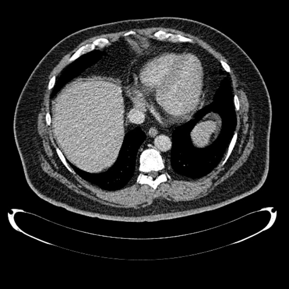 Bosniak renal cyst - type IV (Radiopaedia 24244-24518 C 14).jpg