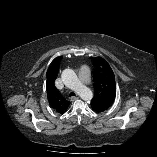Bovine aortic arch - right internal mammary vein drains into the superior vena cava (Radiopaedia 63296-71875 A 39).jpg