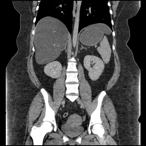 Bowel and splenic infarcts in acute lymphocytic leukemia (Radiopaedia 61055-68913 B 38).jpg