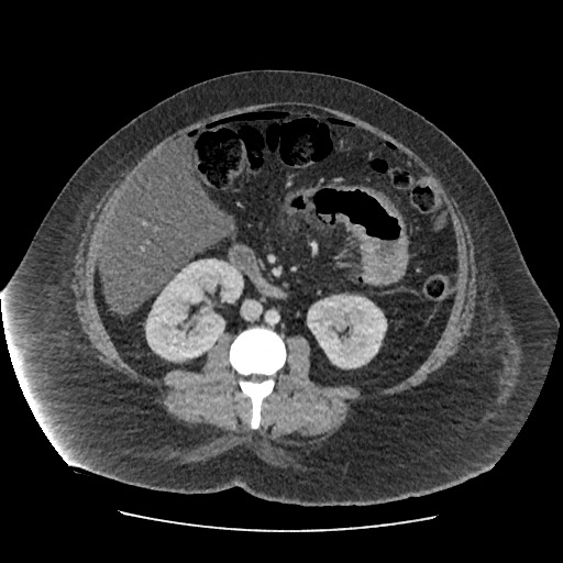 File:Bowel and splenic infarcts in acute lymphocytic leukemia (Radiopaedia 61055-68915 A 69).jpg