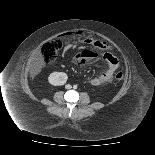 Bowel and splenic infarcts in acute lymphocytic leukemia (Radiopaedia 61055-68915 A 78).jpg