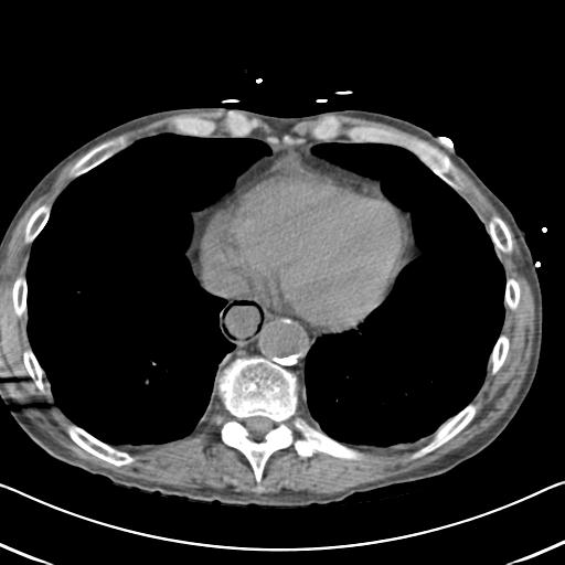 Bowel infarction (Radiopaedia 30296-30933 Axial non-contrast 3).jpg