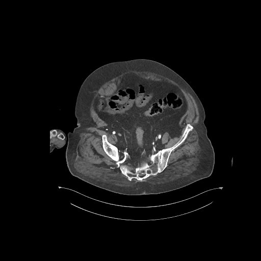 File:Bowel ischemia secondary to SMA occlusion with extensive portomesenteric venous gas (Radiopaedia 54656-60871 A 7).jpg