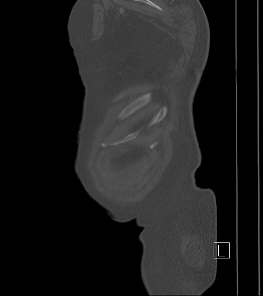 Bowel ischemia secondary to SMA occlusion with extensive portomesenteric venous gas (Radiopaedia 54656-60871 Sagittal bone window 2).jpg