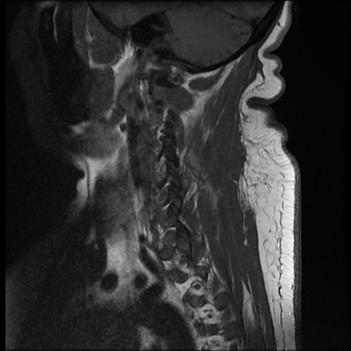 File:Brachial plexopathy (Radiopaedia 21844-21806 Sagittal T1 1).jpg