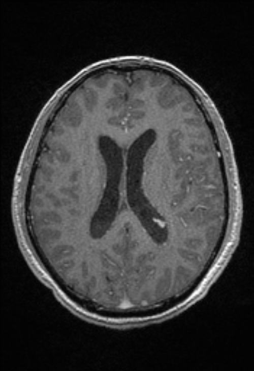 Brain abscess with ventriculitis (Radiopaedia 85703-101495 Axial T1 C+ 108).jpg