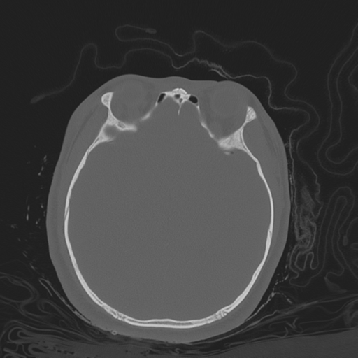 Brain contusions, internal carotid artery dissection and base of skull fracture (Radiopaedia 34089-35339 Axial bone window 73).png