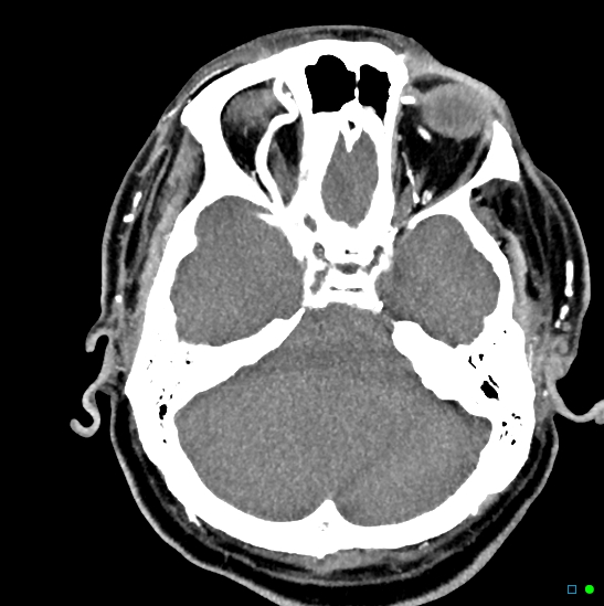 File:Brain death on MRI and CT angiography (Radiopaedia 42560-45841 B 37).jpg