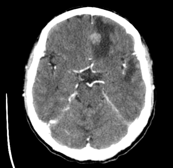 File:Brain metastases from lung cancer (Radiopaedia 24480-24781 Axial C+ delayed 20).jpg