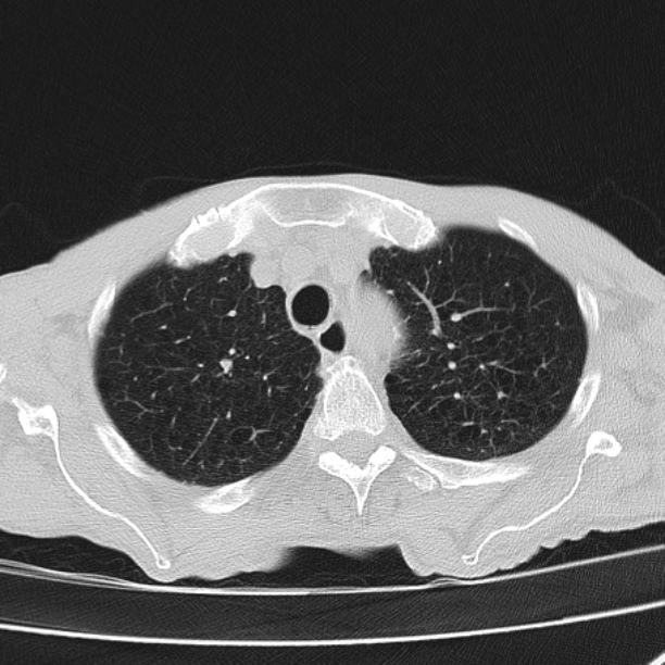 Brain metastases from lung cancer (Radiopaedia 27849-28093 Axial lung window 14).jpg