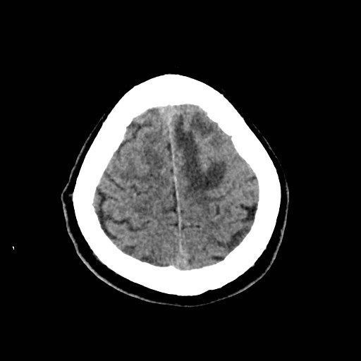 File:Brain metastases from lung cancer (Radiopaedia 83839-99027 Axial non-contrast 31).jpg