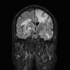 Brain metastases from lung cancer (Radiopaedia 83839-99028 Coronal FLAIR 37).jpg