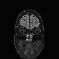 Brain metastases from lung cancer (Radiopaedia 83839-99028 Coronal FLAIR 7).jpg