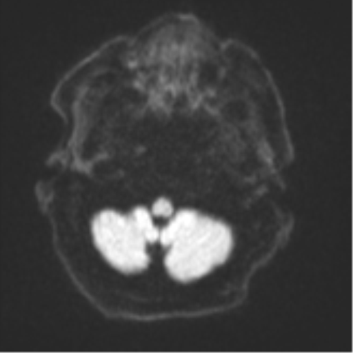 Brain metastasis (lung cancer) (Radiopaedia 48289-53179 Axial DWI 30).png