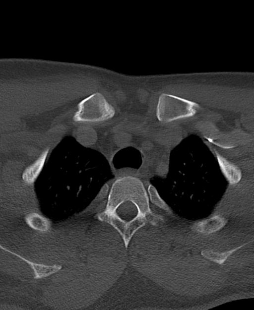 Branchial cleft cyst (Radiopaedia 31167-31875 Axial bone window 74).jpg