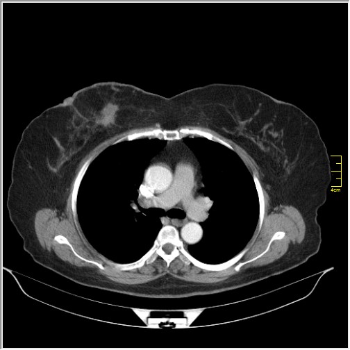File:Breast cancer on thorax CT (Radiopaedia 60571-68275 A 42).JPG
