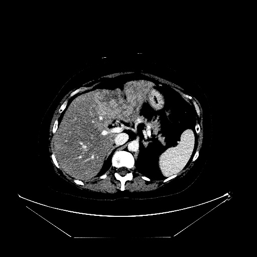 File:Breast cancer pseudocirrhosis with lobar invovlement (Radiopaedia 81080-94670 Axial liver window 51).jpg