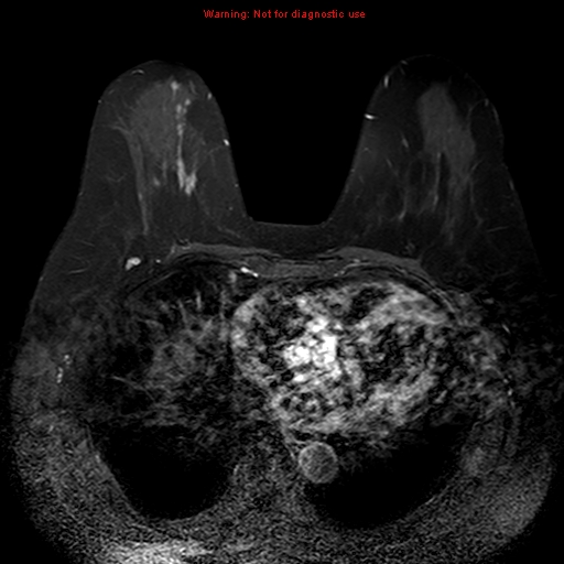 File:Breast carcinoma (multicentric multifocal in mammary Paget disease) (Radiopaedia 50966-56512 Axial T1 C+ fat sat 4).jpg
