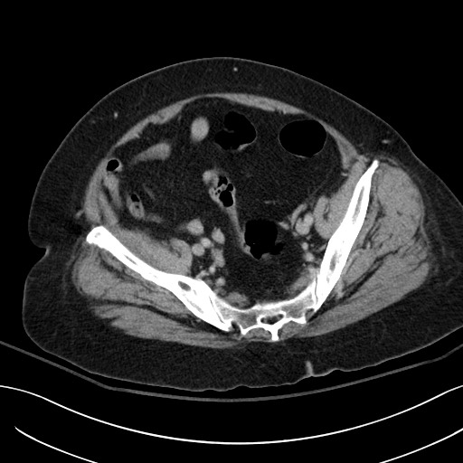 Breast carcinoma with pathological hip fracture (Radiopaedia 60314-67974 B 57).jpg
