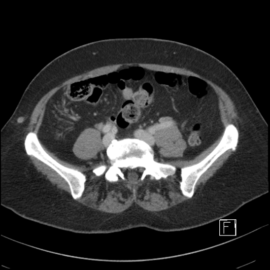 File:Breast metastases from renal cell cancer (Radiopaedia 79220-92225 C 77).jpg