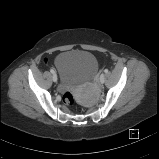 File:Breast metastases from renal cell cancer (Radiopaedia 79220-92225 C 96).jpg