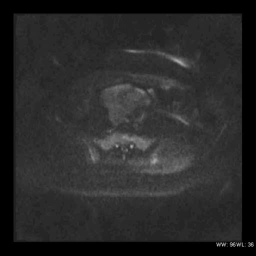 File:Broad ligament fibroid (Radiopaedia 49135-54241 Axial DWI 12).jpg
