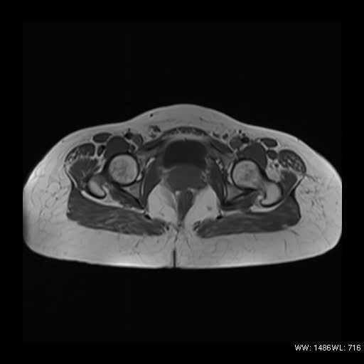 File:Broad ligament fibroid (Radiopaedia 49135-54241 Axial T1 13).jpg